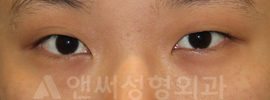Answer Plastic Surgery case 715: Before