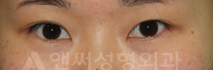 Answer Plastic Surgery case 718: Before