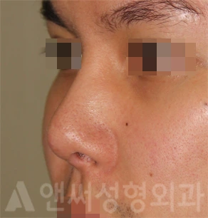 Answer Plastic Surgery case 717: Before