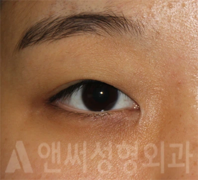 Answer Plastic Surgery case 714: Before
