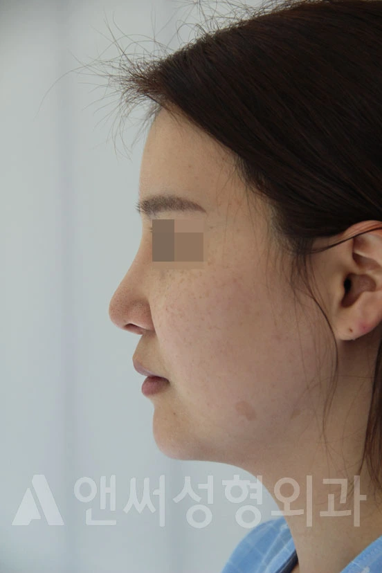 Answer Plastic Surgery case 706: Before