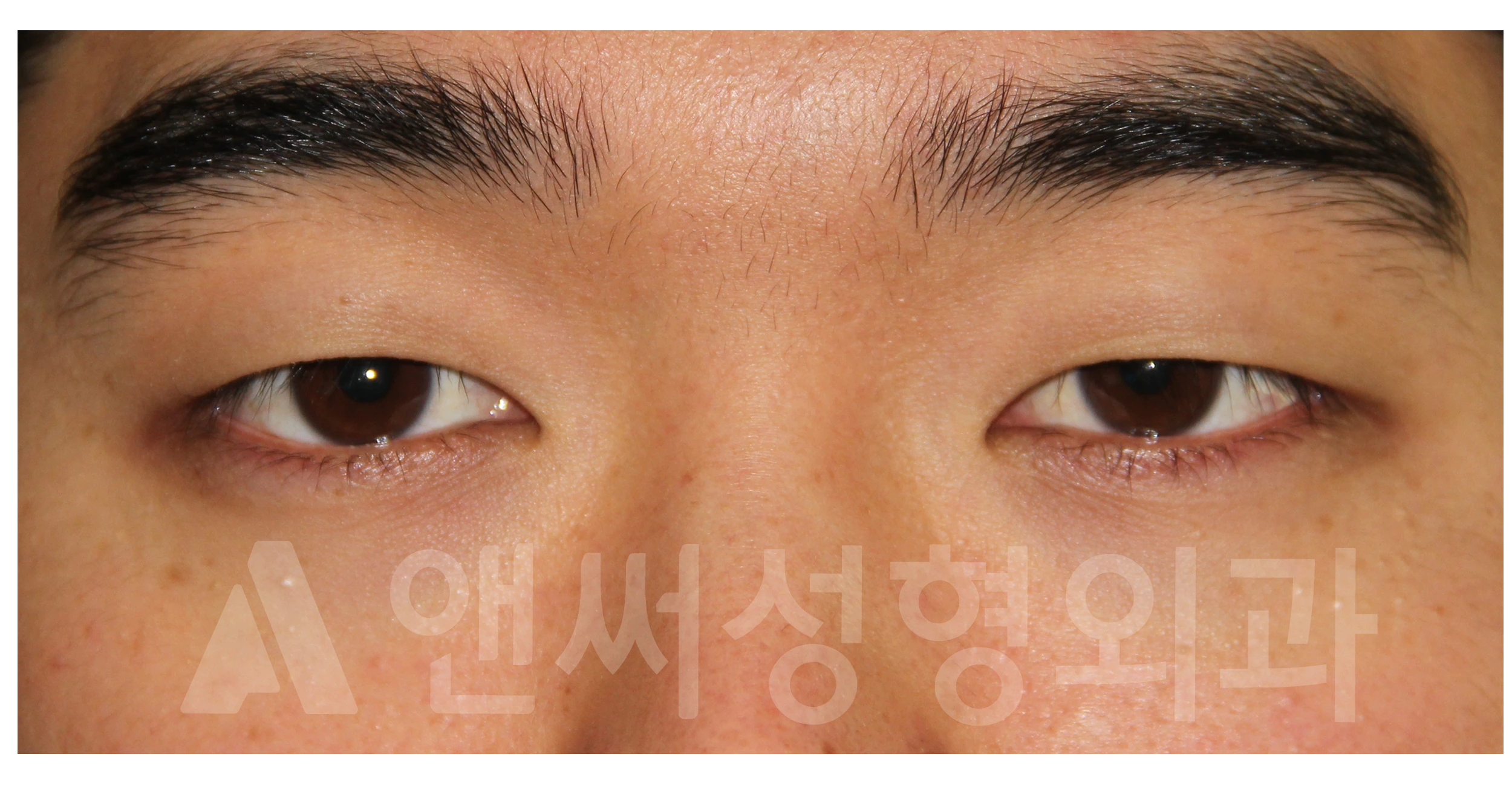 Answer Plastic Surgery case 705: Before