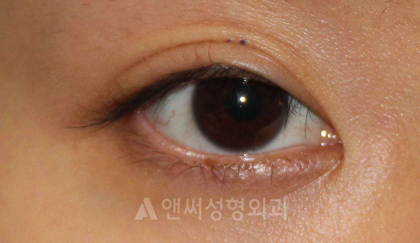 Answer Plastic Surgery case 702: Before