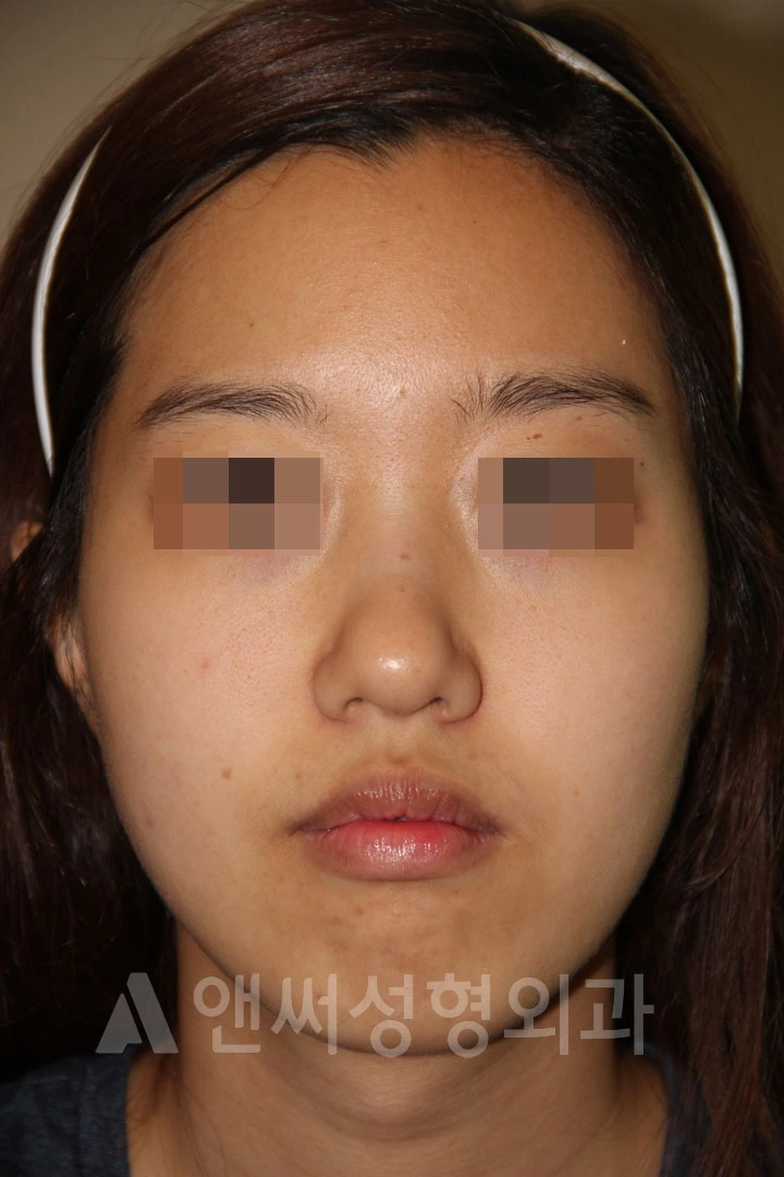 Answer Plastic Surgery case 701: Before