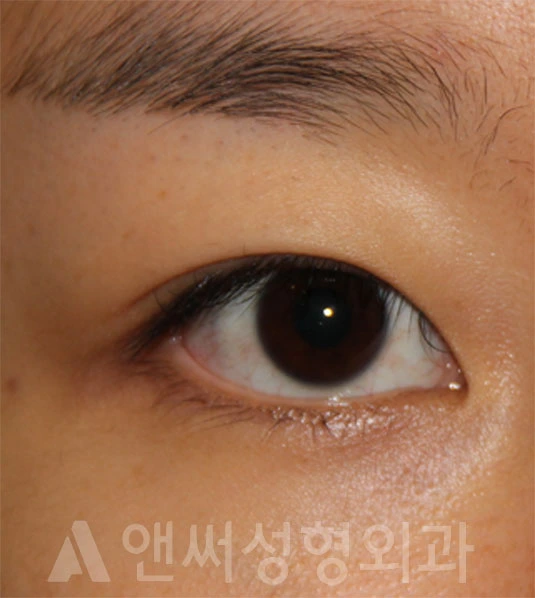 Answer Plastic Surgery case 700: Before