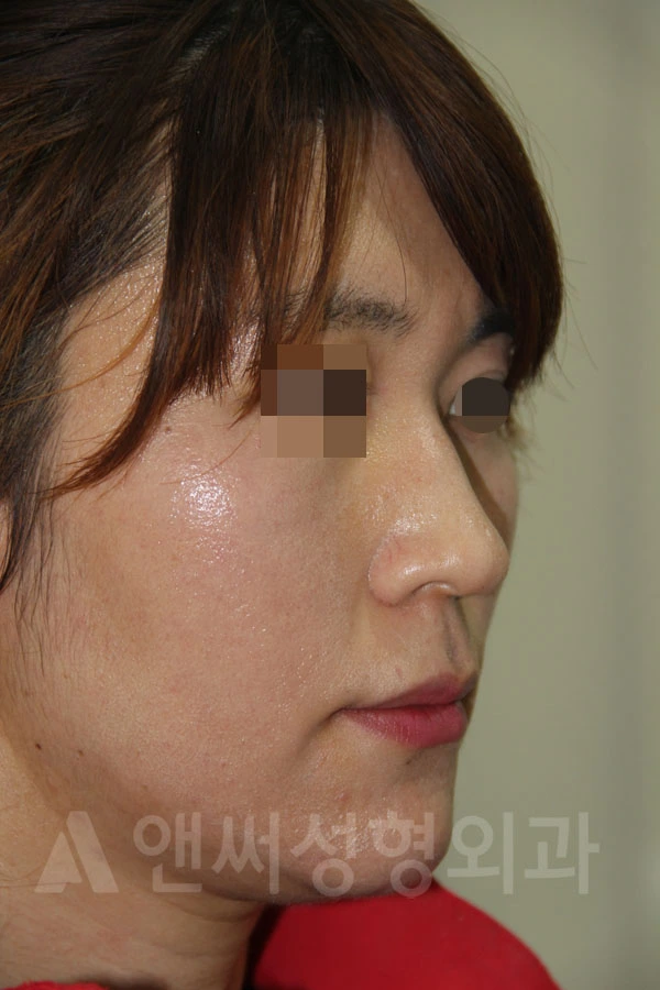 Answer Plastic Surgery case 710: Before