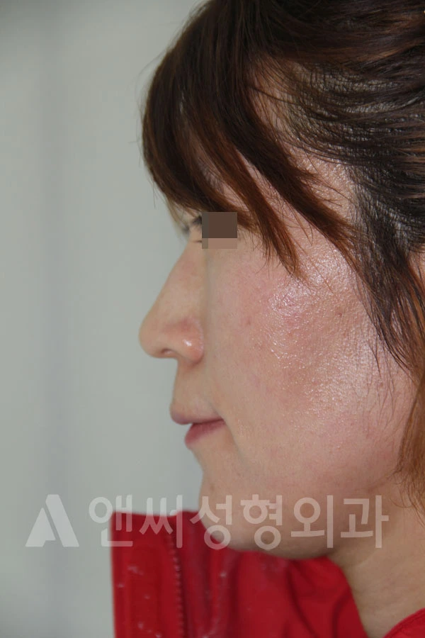 Answer Plastic Surgery case 708: Before