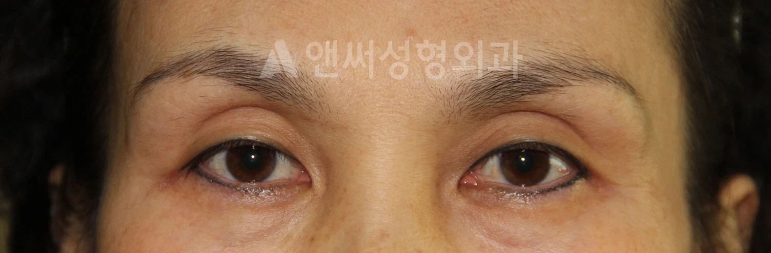 Answer Plastic Surgery case 707: Before