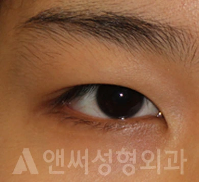 Answer Plastic Surgery case 698: Before