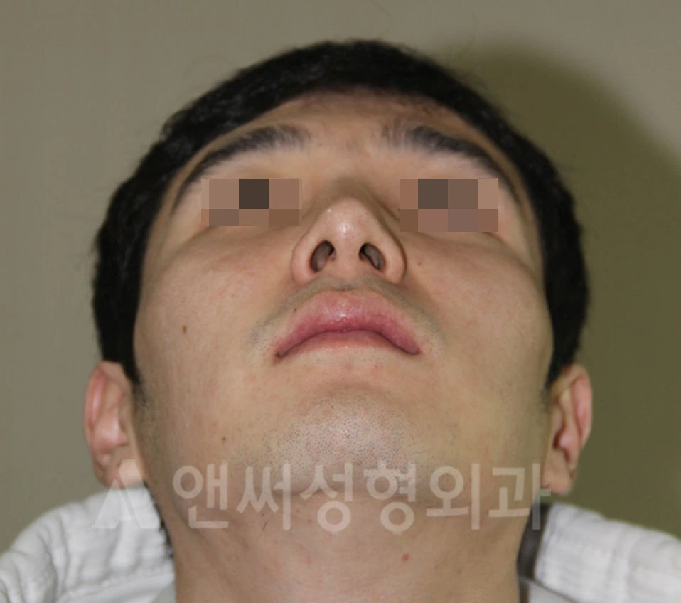 Answer Plastic Surgery case 697: Before