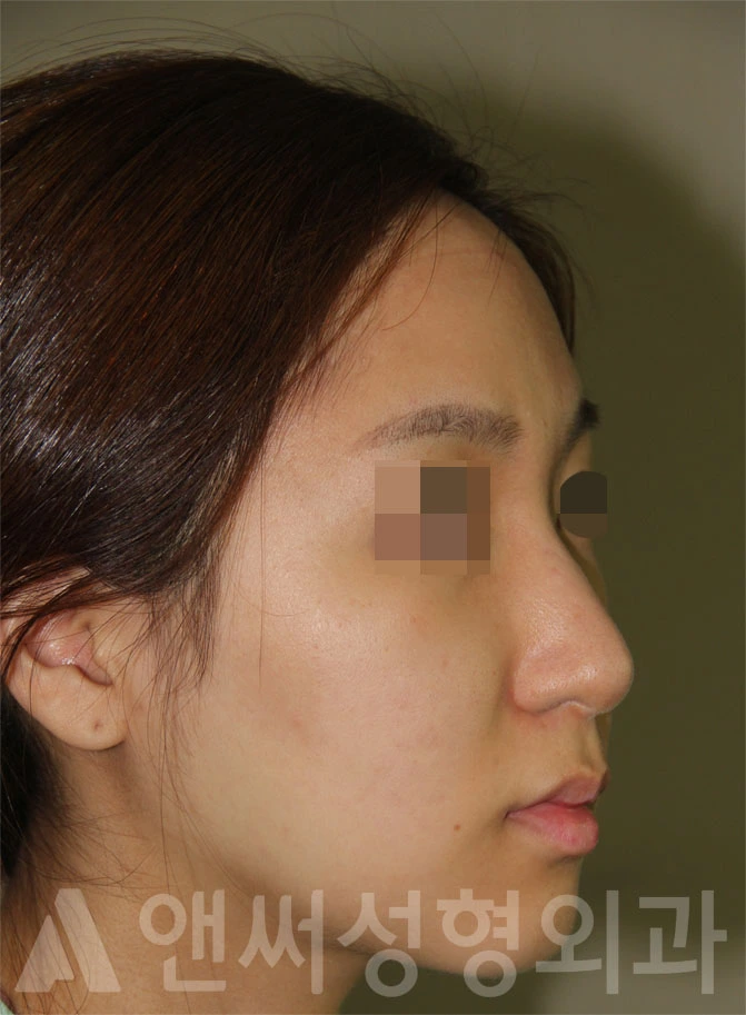 Answer Plastic Surgery case 695: Before