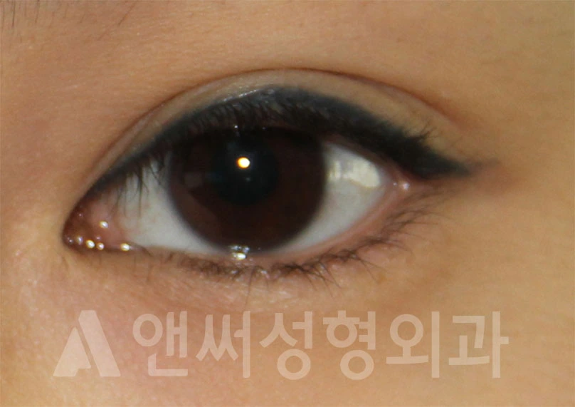 Answer Plastic Surgery case 693: Before