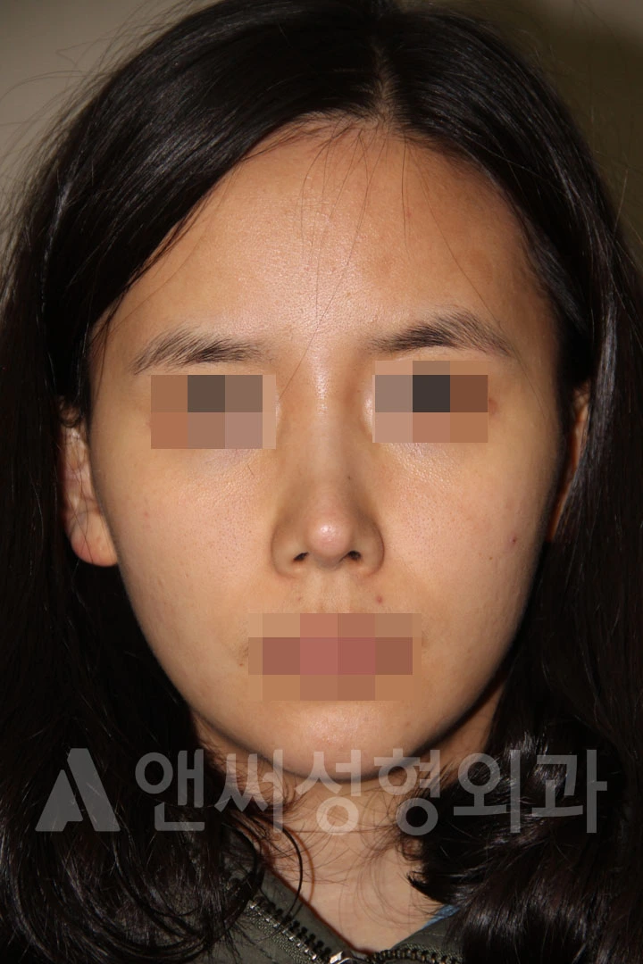 Answer Plastic Surgery case 691: Before