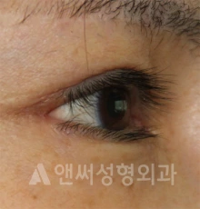 Answer Plastic Surgery case 690: After