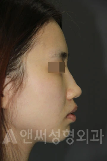 Answer Plastic Surgery case 687: Before