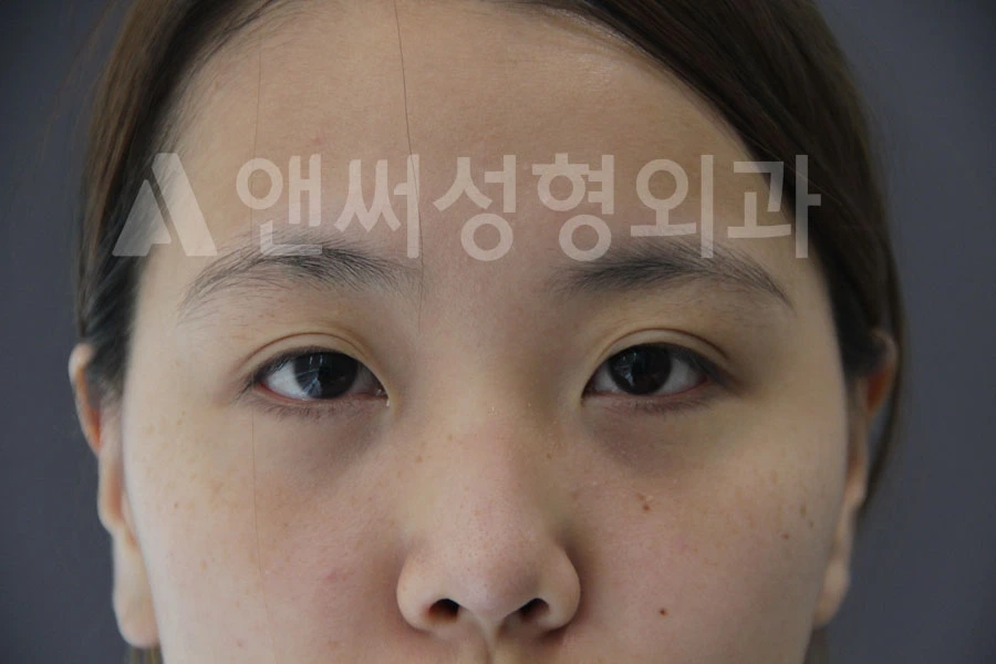 Answer Plastic Surgery case 684: Before