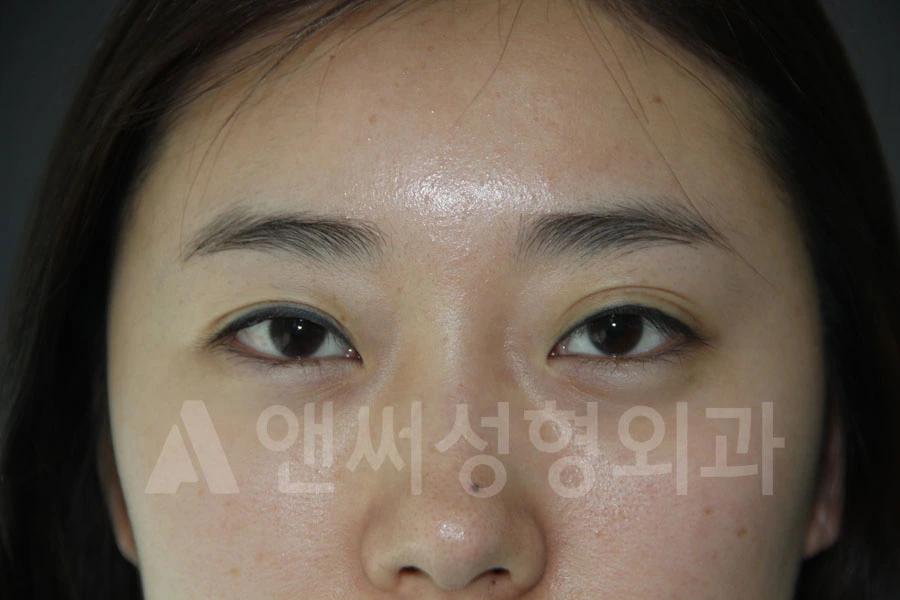 Answer Plastic Surgery case 683: Before
