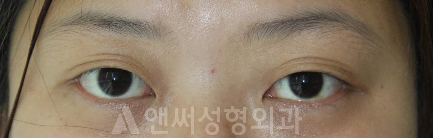 Answer Plastic Surgery case 680: Before