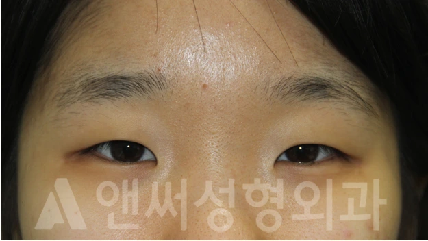 Answer Plastic Surgery case 679: Before