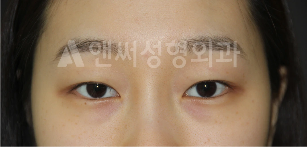Answer Plastic Surgery case 677: Before