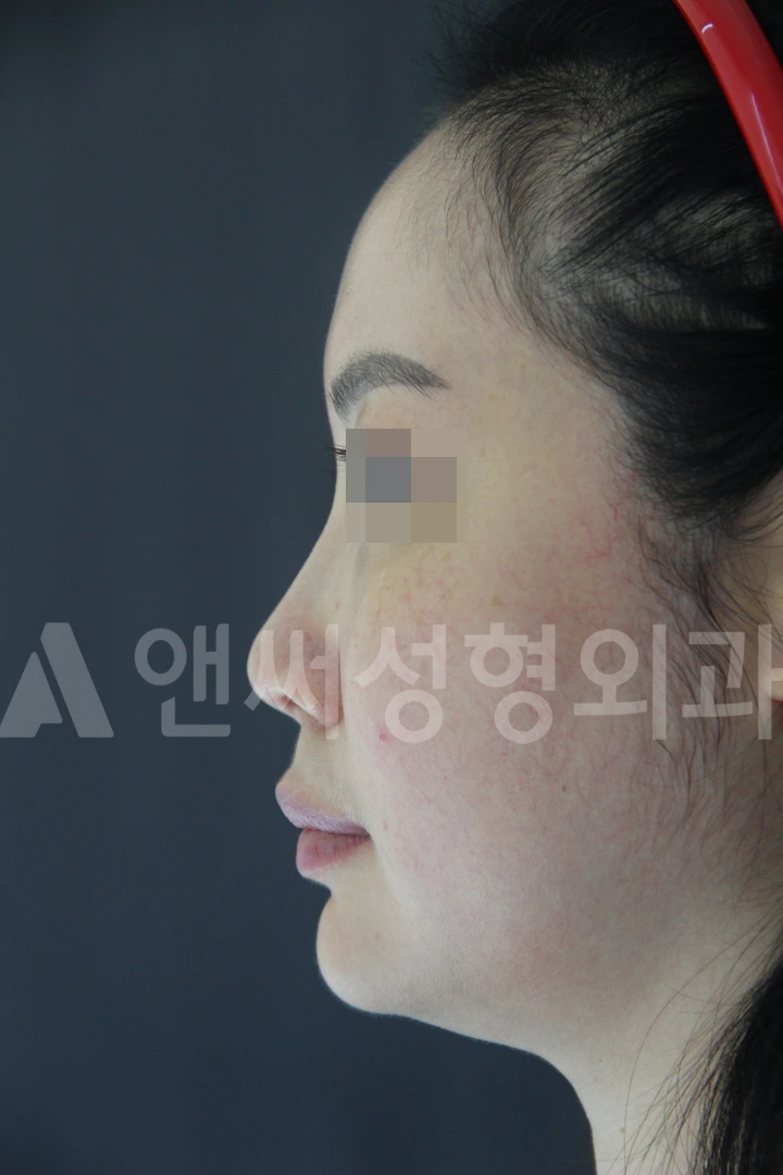 Answer Plastic Surgery case 676: Before