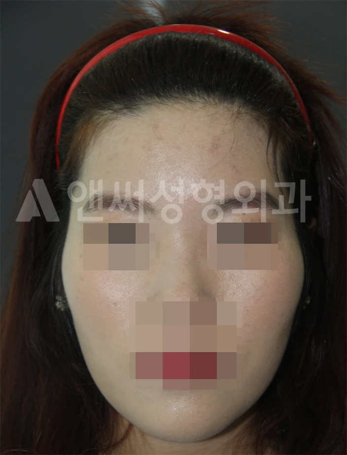Answer Plastic Surgery case 675: Before