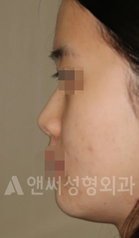 Answer Plastic Surgery case 671: Before