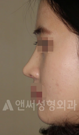Answer Plastic Surgery case 671: After