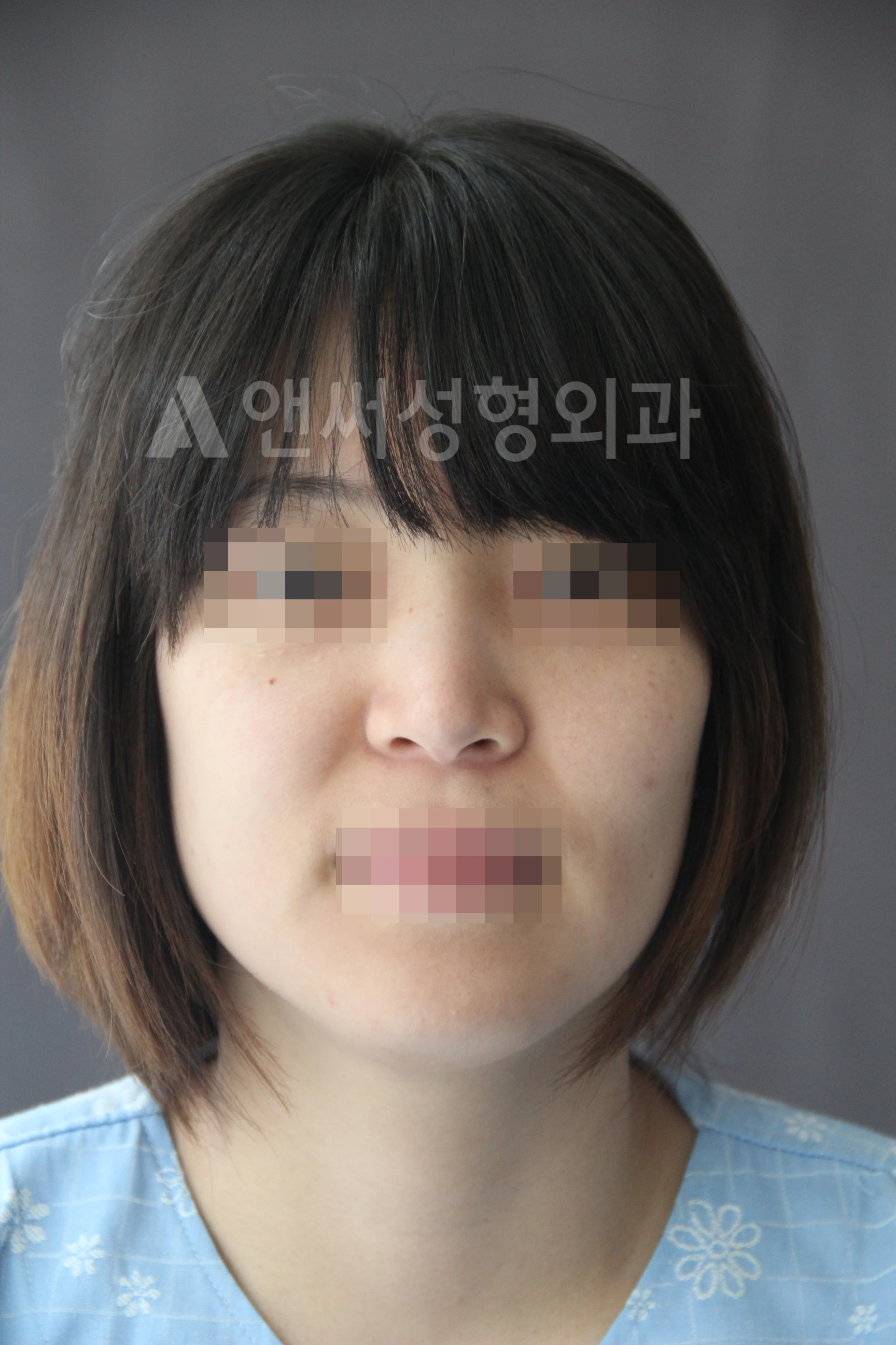 Answer Plastic Surgery case 669: Before