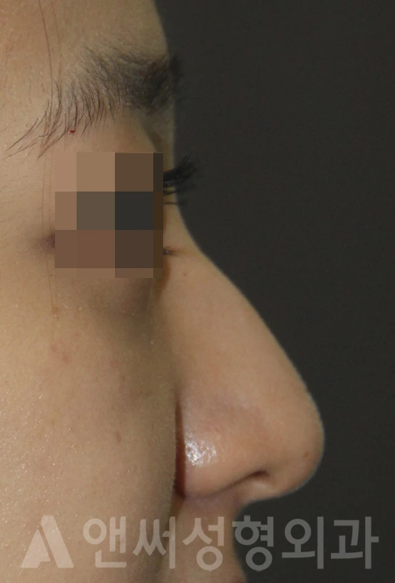 Answer Plastic Surgery case 667: Before