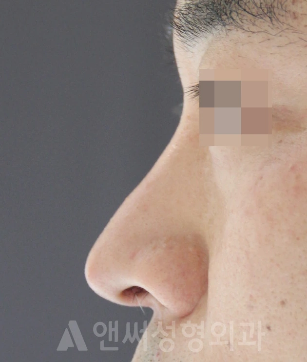 Answer Plastic Surgery case 666: Before