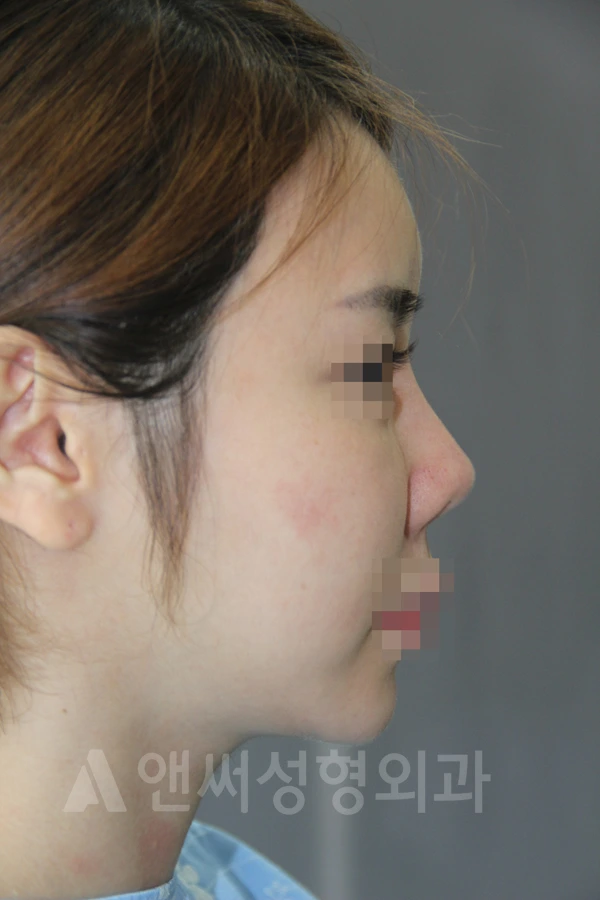Answer Plastic Surgery case 665: Before