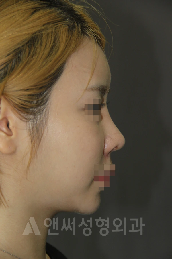 Answer Plastic Surgery case 665: After