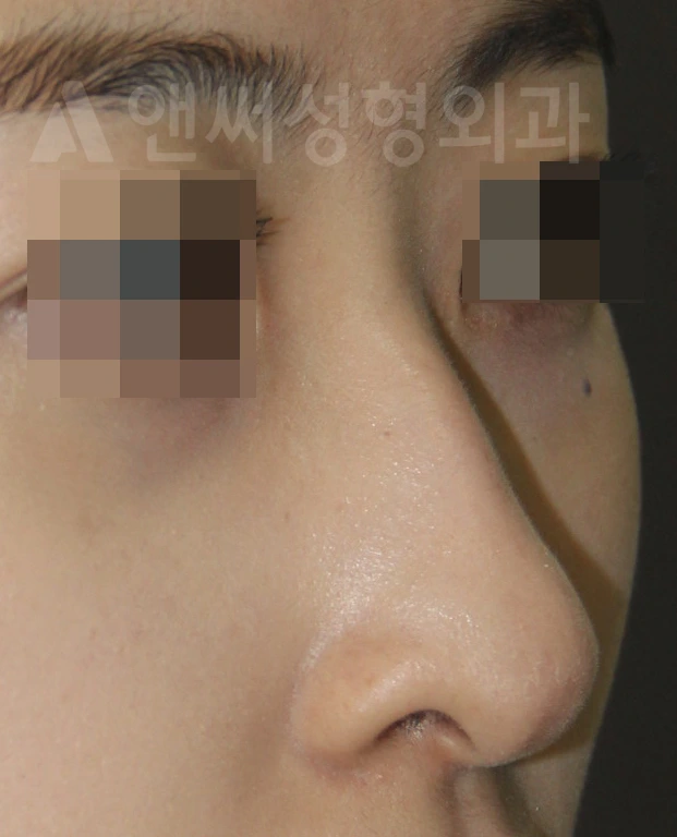 Answer Plastic Surgery case 664: Before