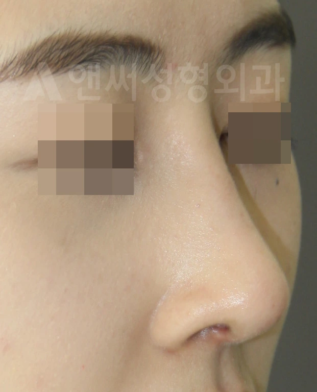 Answer Plastic Surgery case 664: After
