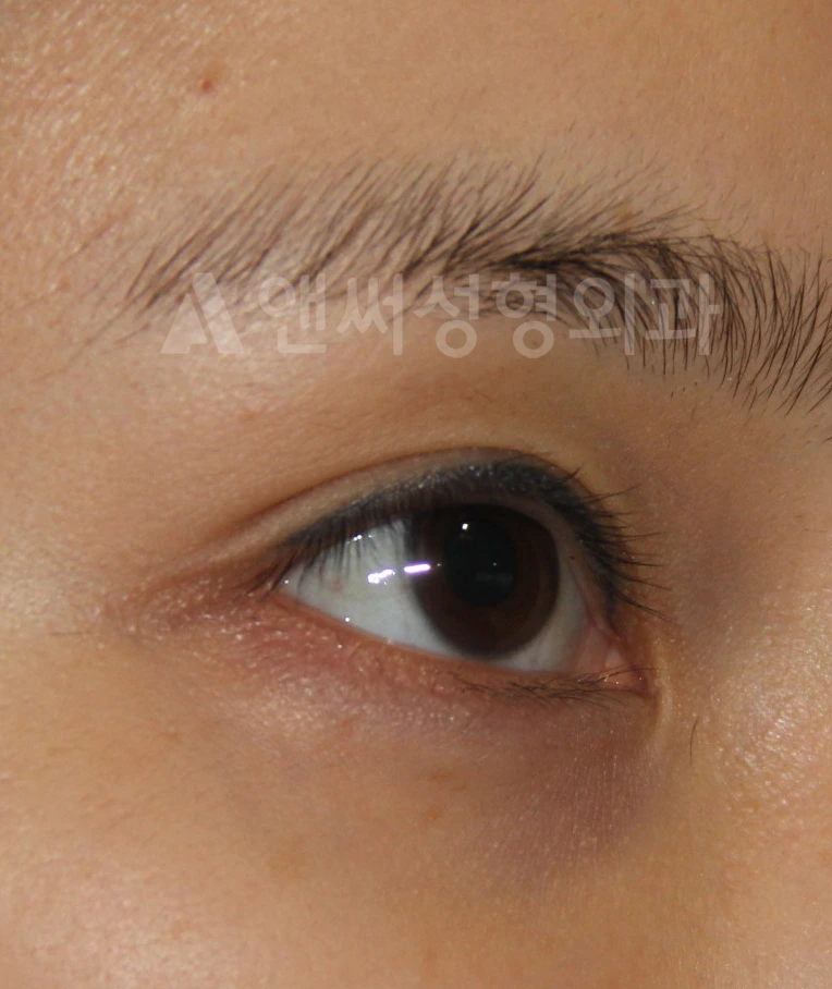 Answer Plastic Surgery case 662: Before
