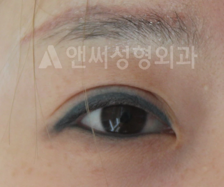Answer Plastic Surgery case 661: Before
