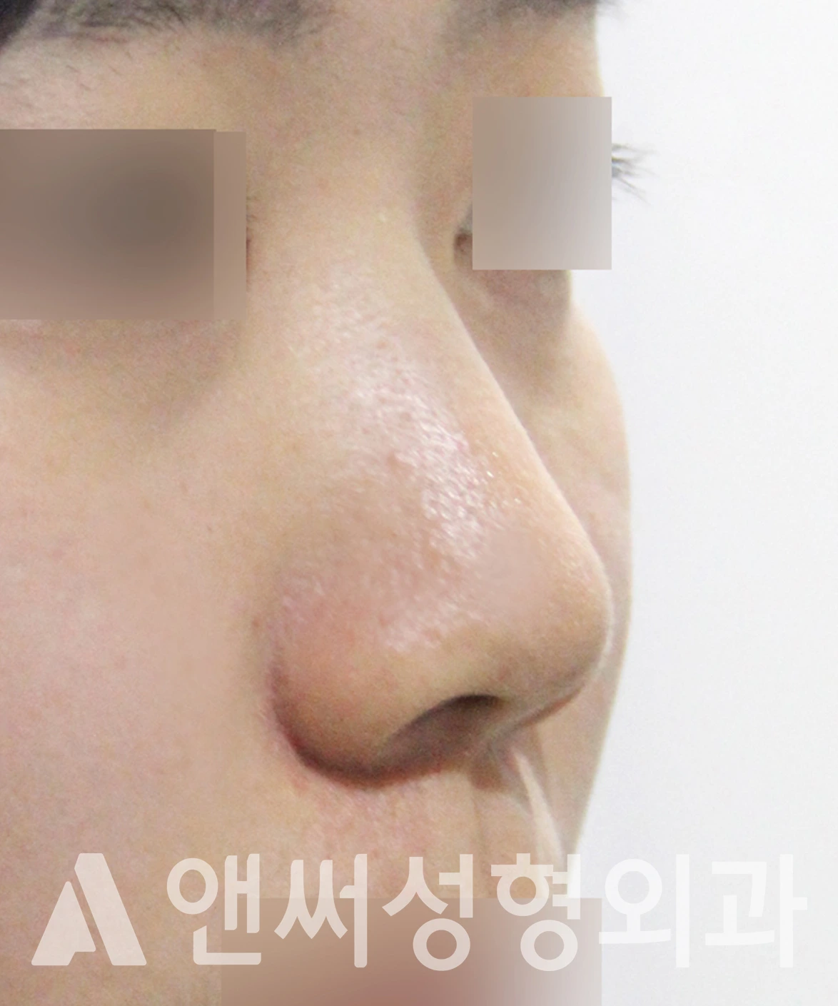 Answer Plastic Surgery case 658: Before