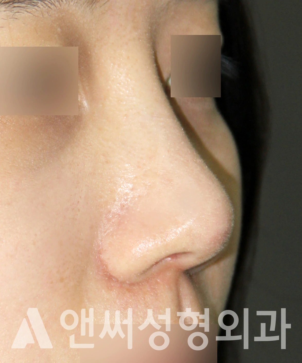 Answer Plastic Surgery case 658: After