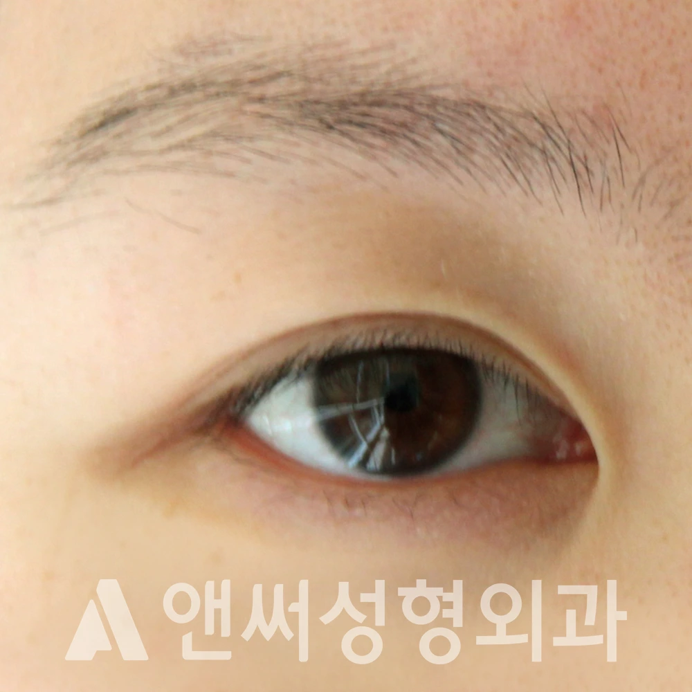 Answer Plastic Surgery case 657: Before