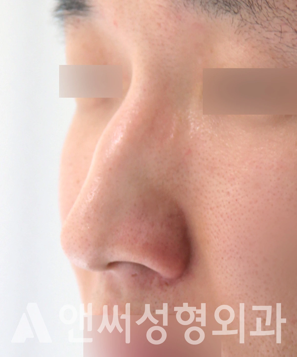 Answer Plastic Surgery case 656: Before