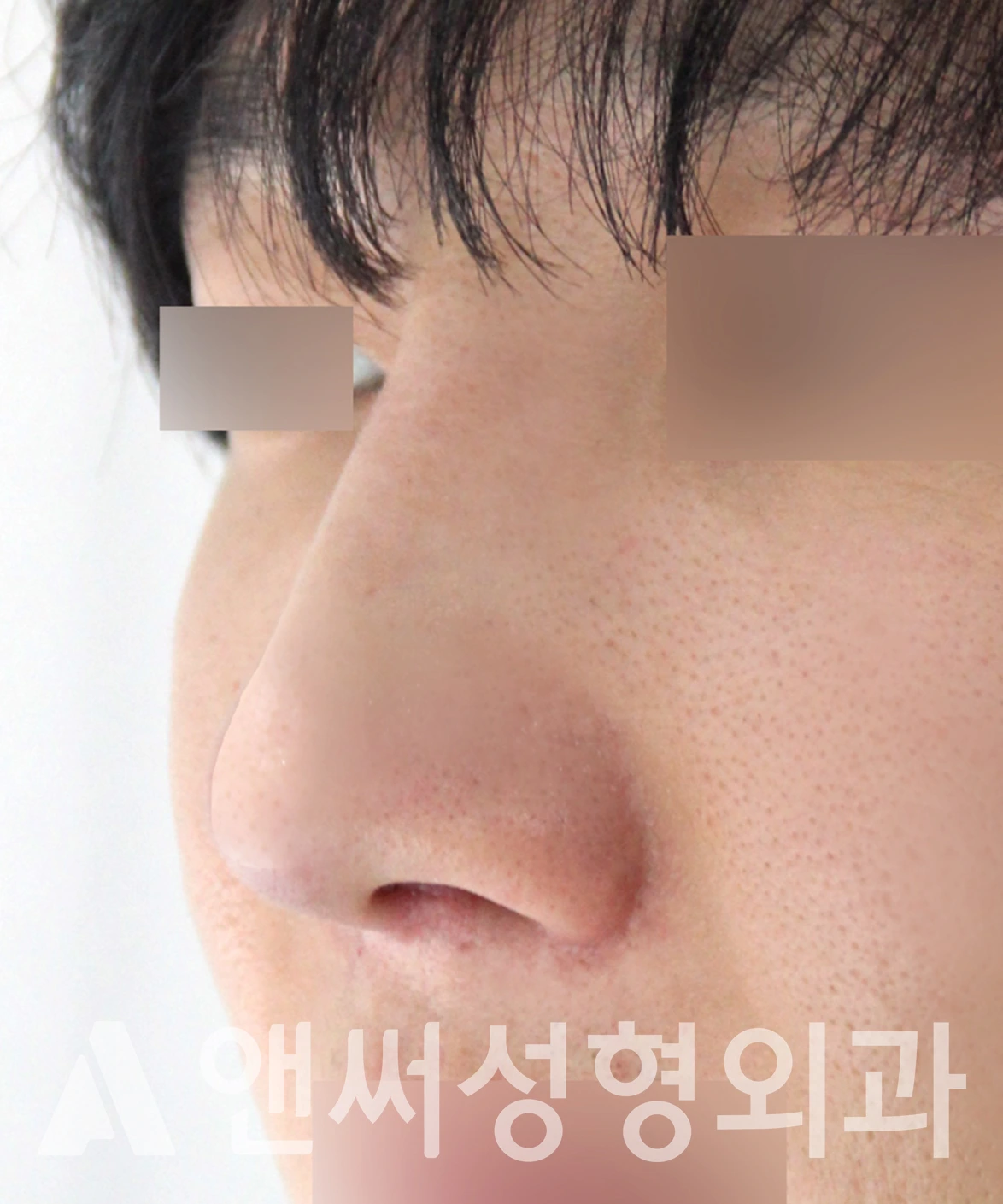 Answer Plastic Surgery case 656: After