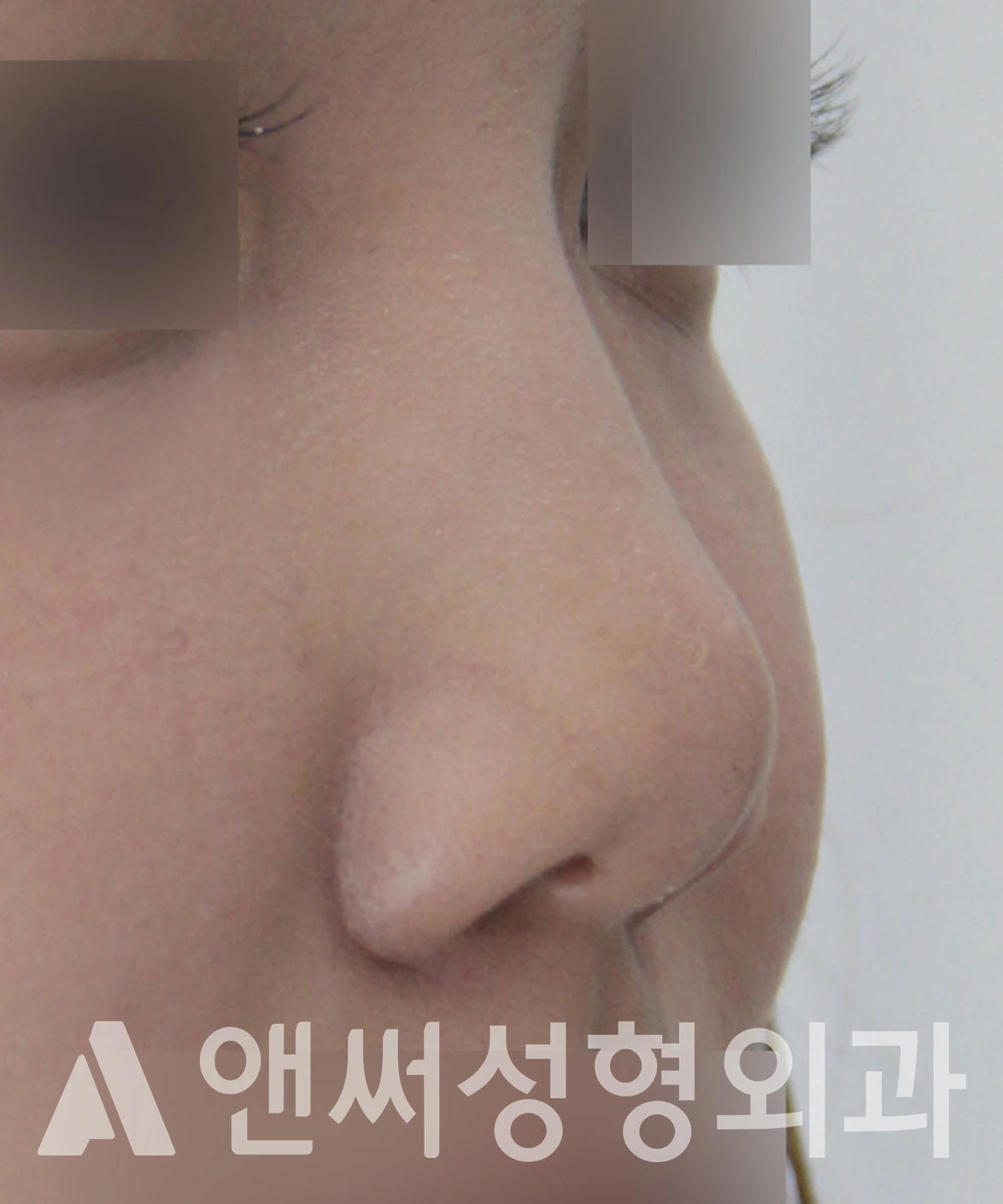 Answer Plastic Surgery case 655: Before