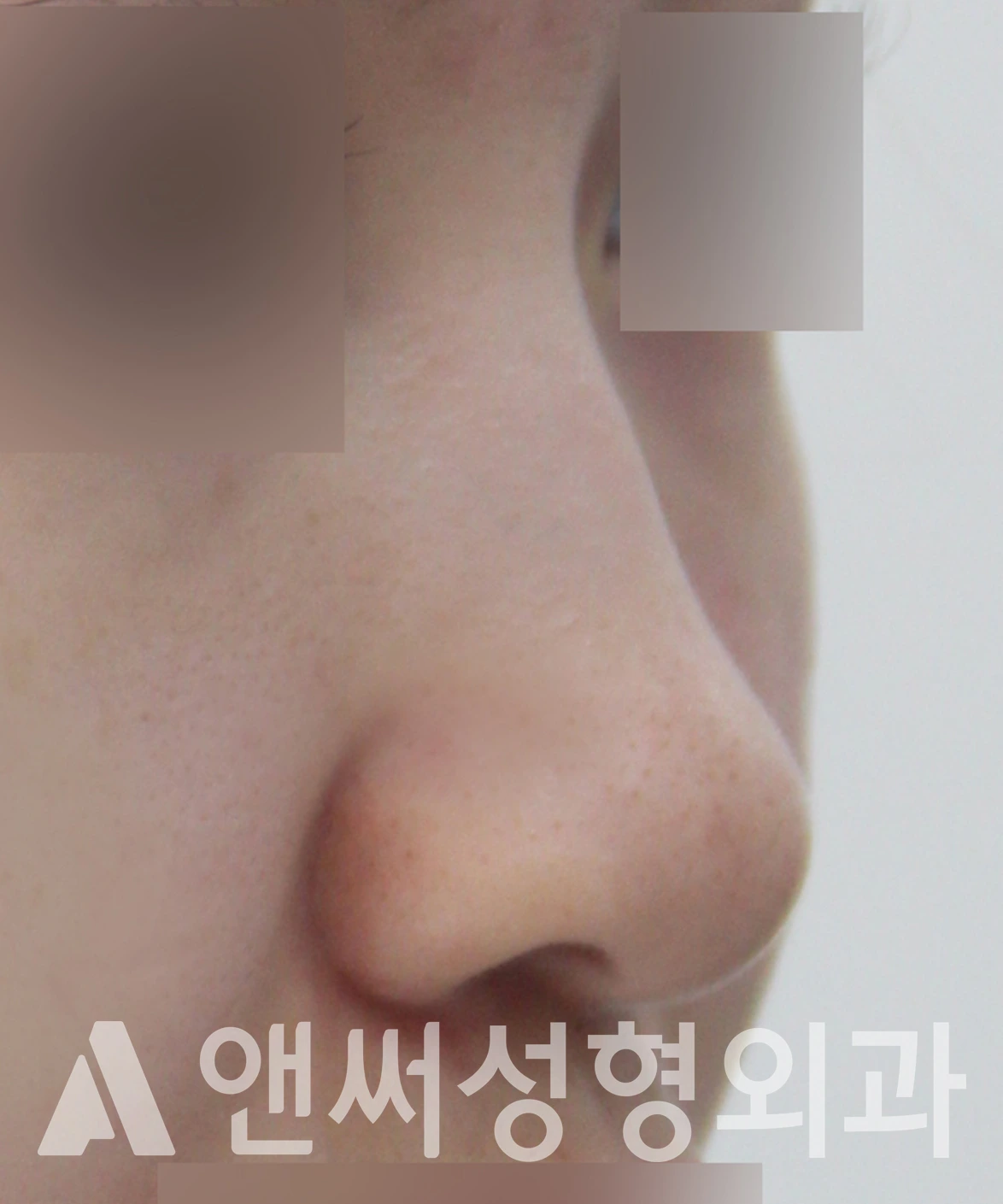 Answer Plastic Surgery case 654: Before
