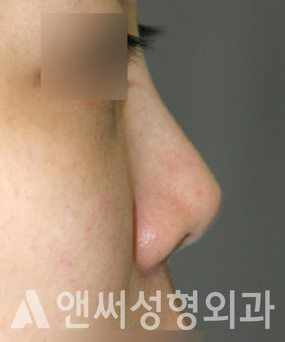 Answer Plastic Surgery case 653: Before