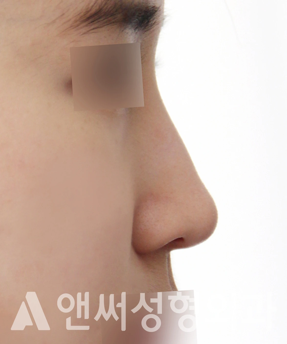 Answer Plastic Surgery case 652: Before