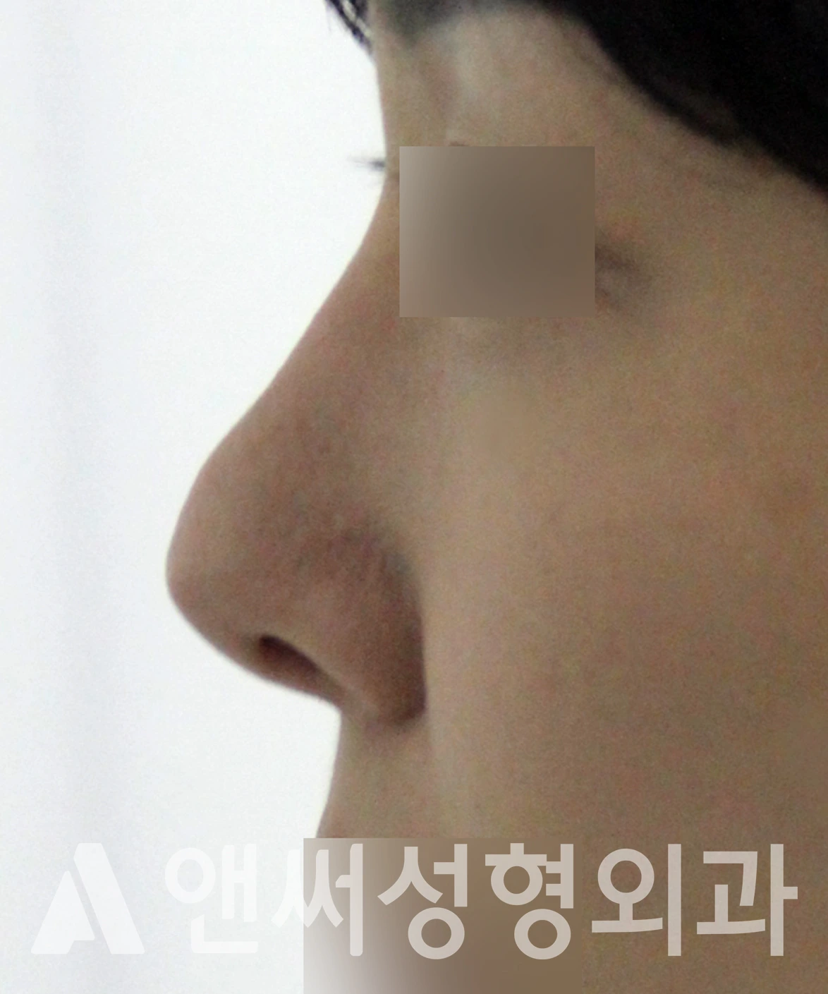 Answer Plastic Surgery case 650: Before
