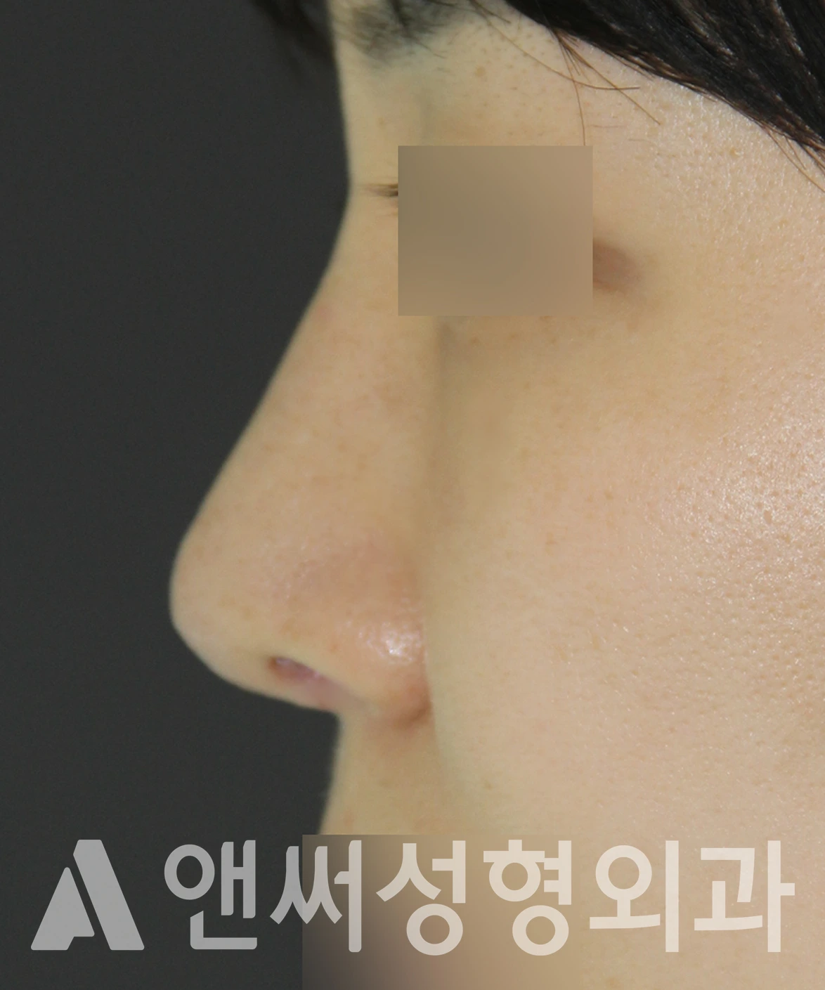 Answer Plastic Surgery case 650: After