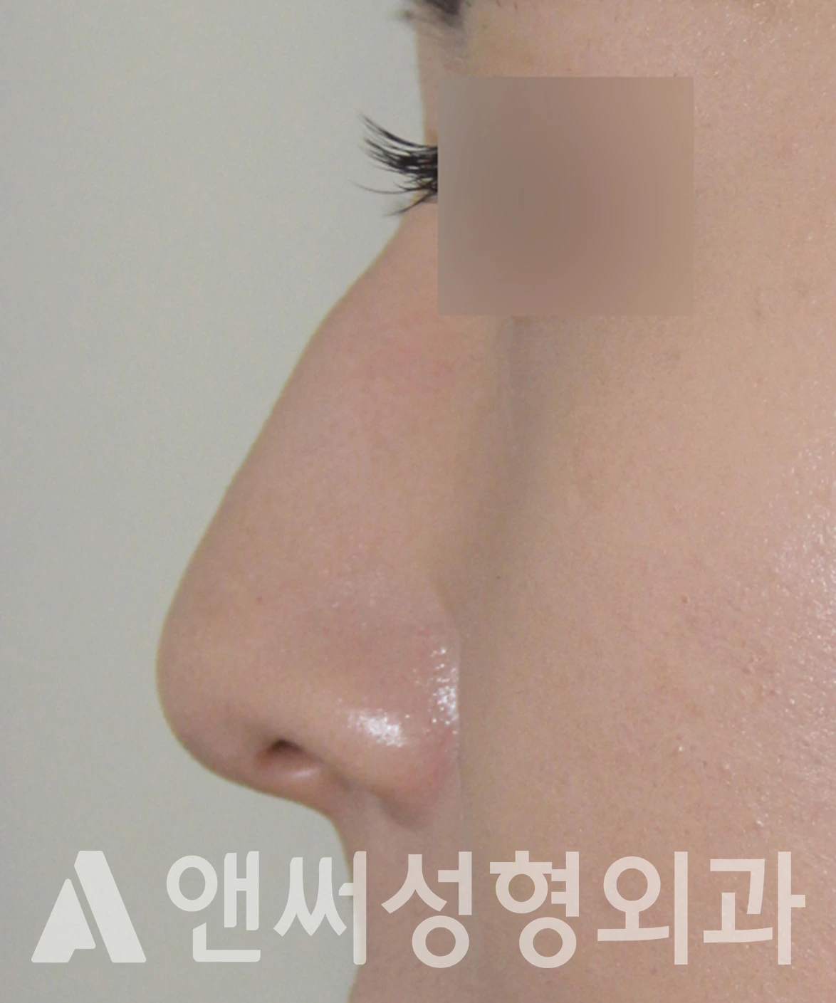 Answer Plastic Surgery case 649: Before