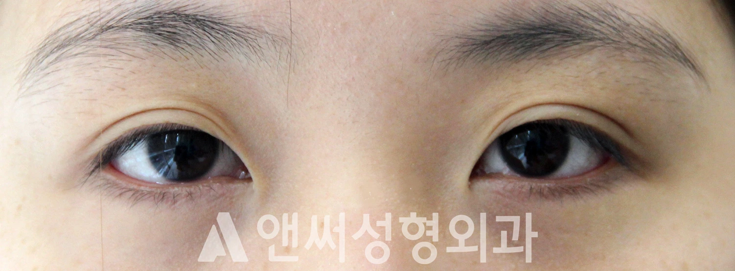 Answer Plastic Surgery case 624: Before